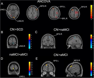 Altered Frequency-Dependent Brain Activation and White Matter Integrity Associated With Cognition in Characterizing Preclinical Alzheimer’s Disease Stages